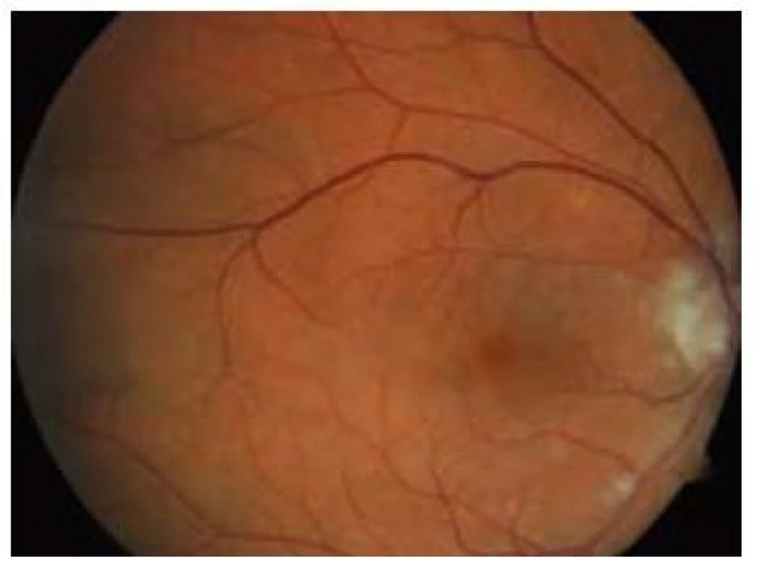 Oční pozadí – pacient, muž, rok narození 1946. Sukcesivní embolizace, cca 48 hod od vzniku prvních obtíží, vizus 0,5.