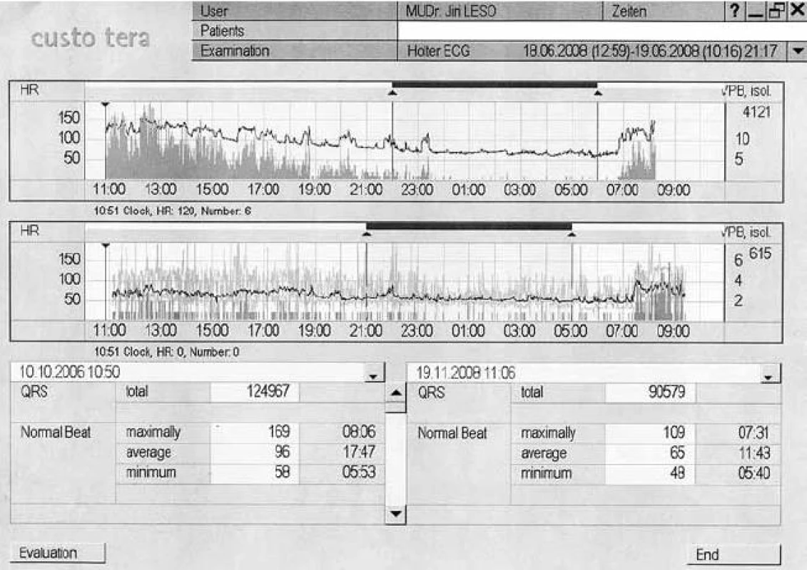 Záznam 24hodinového monitorování EKG – porovnání záznamu z října 2006 a června 2008.