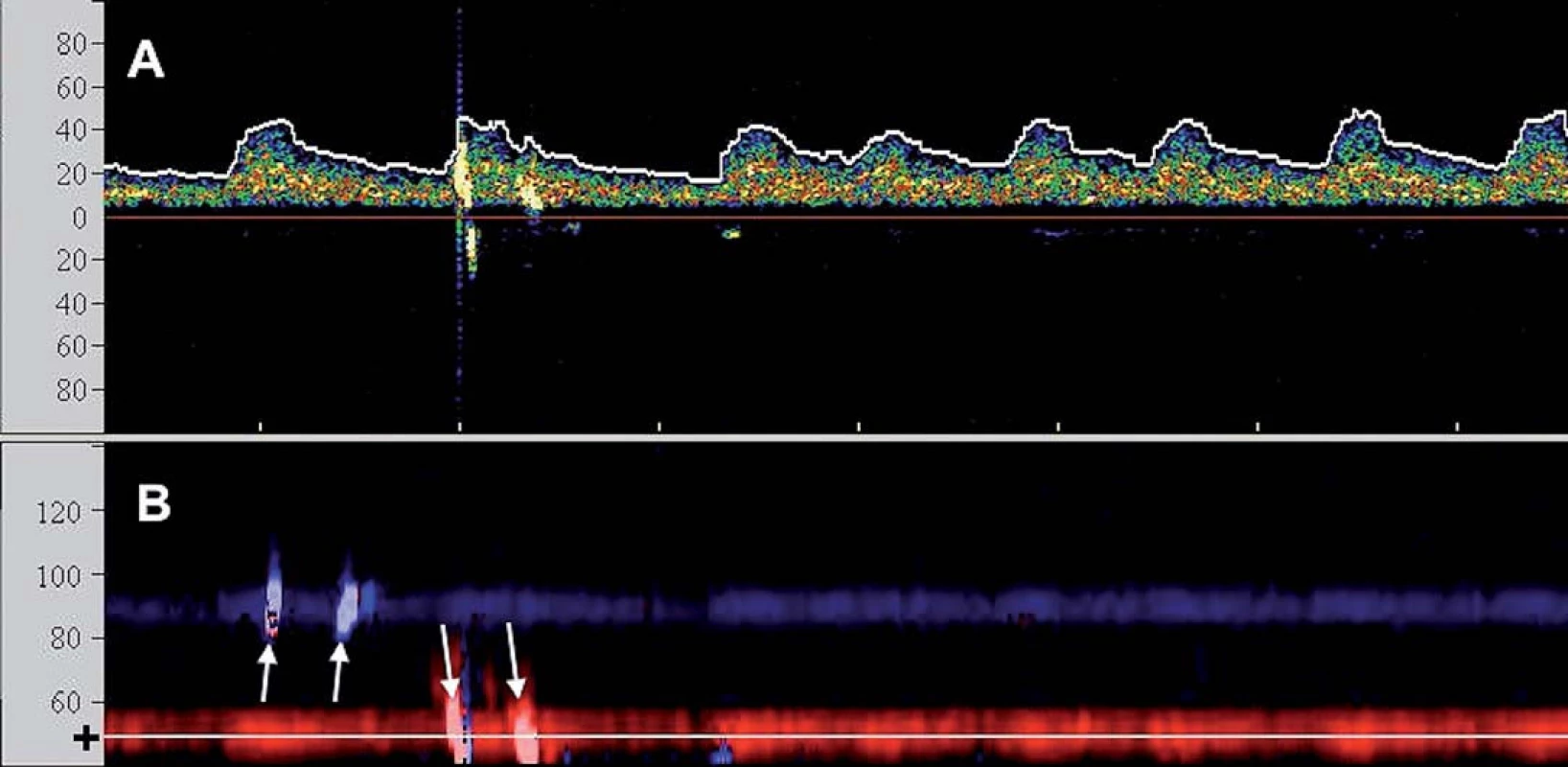 TCD monitorace CAS u pacienta s fi brilací síní: A) Spektrální (průtoková) křivka s oblastí zvoleného vzorkovacího objemu v hloubce 50 mm odpovídající M1/M2 úseku střední cerebrální arterie (škála x osy v cm/s). Zachyceny 2 HITS. B) Barevně kódované M-mode zobrazení (hloubkový řez (škála x osy v mm)) zachycující dopplerovský signál z ipsilaterální arteria cerebri media (k sondě – červeně) a v kontralaterální arteria cerebri media (od sondy – modře). Nastavená oblast zájmu spektrálního vyšetření (A) je zobrazena tenkou linkou a (+). Bilaterální HITS označeny šipkami.