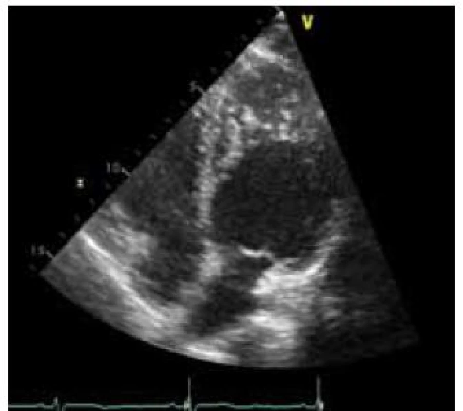 Echokardiografický obraz nekompaktní kardiomyopatie – predominantní lokalizace je mid-laterální a apikální.