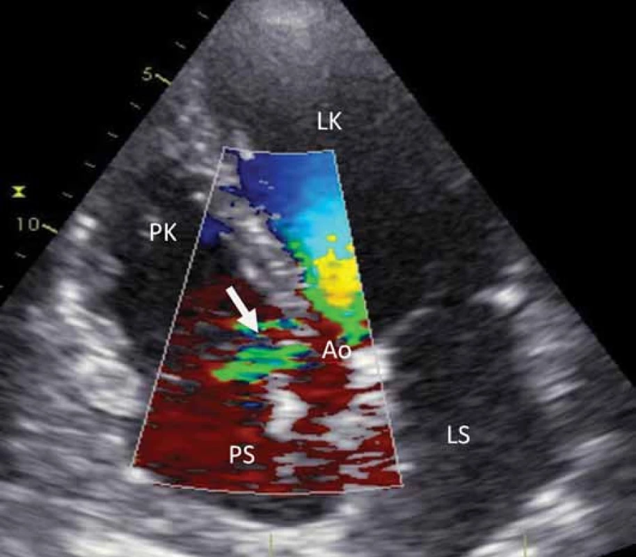 Transthorakální echokardiografie (5CH – 5 dutinová projekce). Šipka ukazuje barevným dopplerem zkratový jet mezi aortou a pravou síní.
