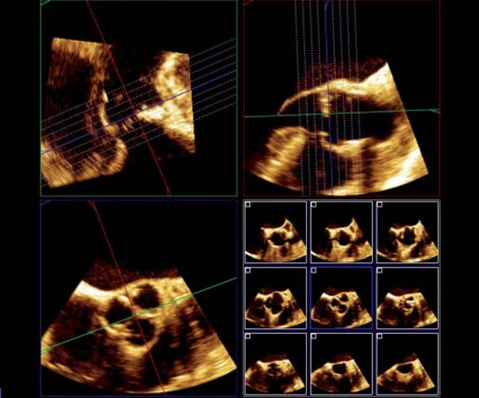 RT 3D TEE aortální chlopně, i-slice tomografie.