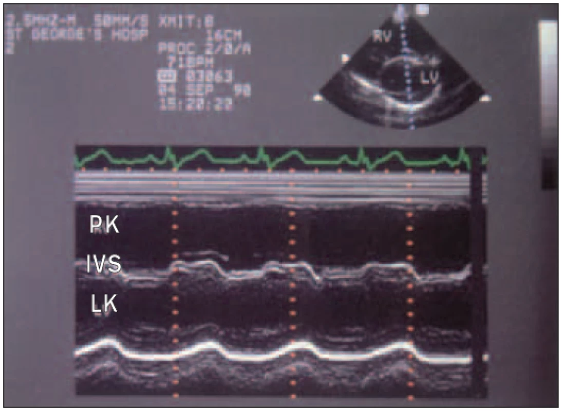 Záznam M-modu u pacienta s defektem septa síní ukazuje zvětšenou pravou komoru a obrácený/reverzní („paradoxní“) pohyb přepážky značící objemové přetížení pravé komory.