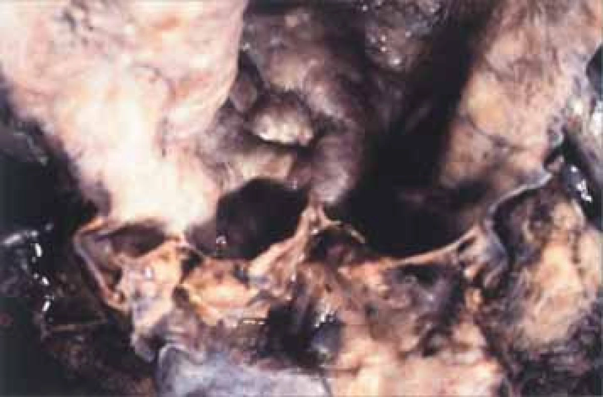 Ankylozující spondylitida s aortální regurgitací. Kořen aorty je dilatován, intima vrásčitá, cípy chlopní zkroucené a scvrklé.