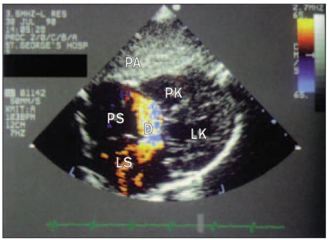 Subkostální 2D-pohled u dítěte s defektem septa síní typu ostium primum. Defekt sahá doprava dolů k atrioventrikulárním chlopním a normální „schodek“ mezi úponovými body trikuspidální a mitrální chlopně chybí. Barevná dopplerovská echokardiografie ukazuje levopravý zkrat.
