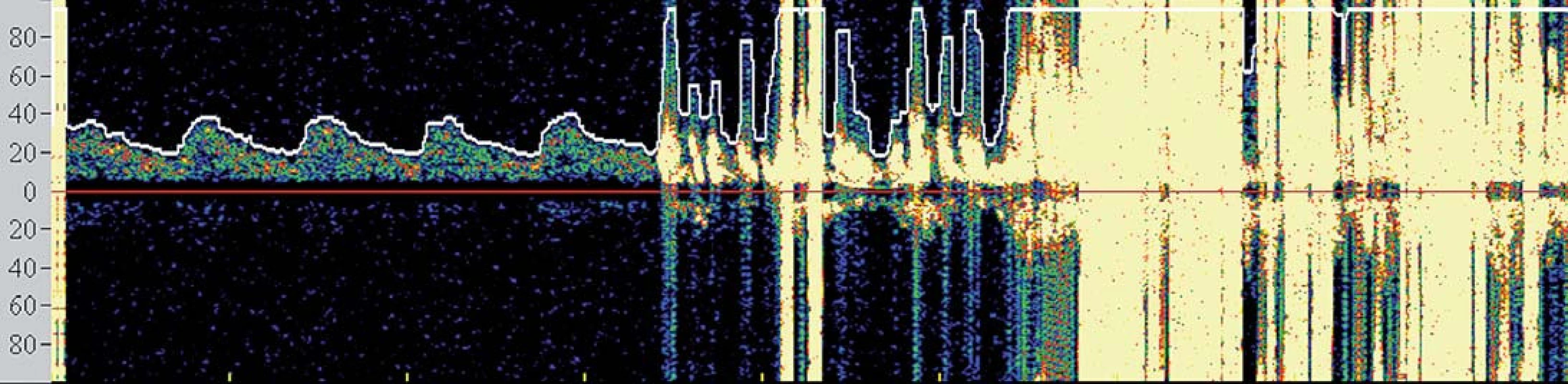 Spektrální křivka znázorňující četné sprchy MES detekované po postdilataci.