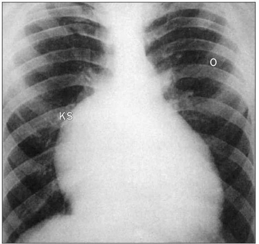 RTG Ebsteinovy anomálie ukazuje plicní oligemii a prominentní pravou konturu srdce.