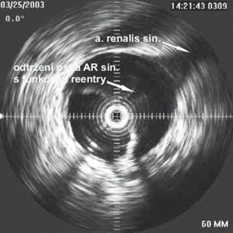 Obraz intravaskulárního ultrazvuku v místě odstupu levé ledvinné tepny. Disekce amputovala ostium tepny a vytvořila zde přirozené funkční reentry.