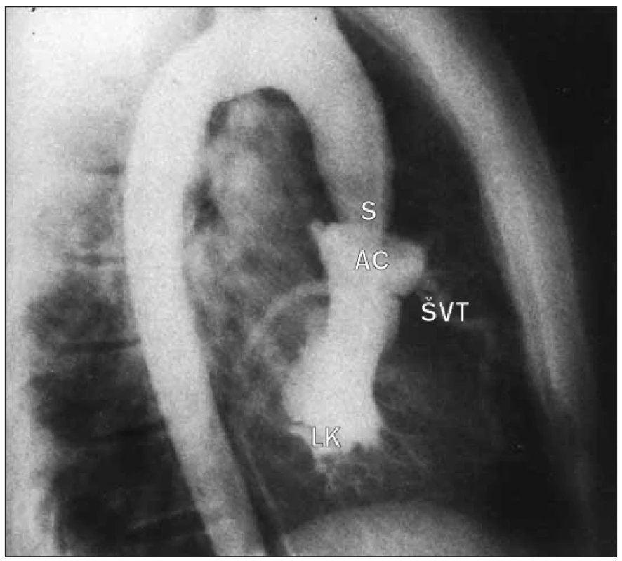 Angiogram levé komory v bočním pohledu ukazuje supravalvulární stenózu a hypertrofii levé komory.