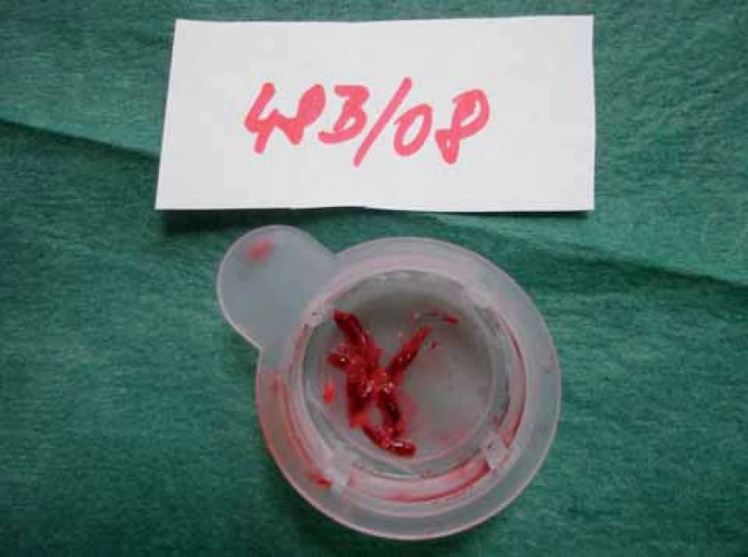 Pacient č. 2 – převážně červený trombus získaný při aspiraci.