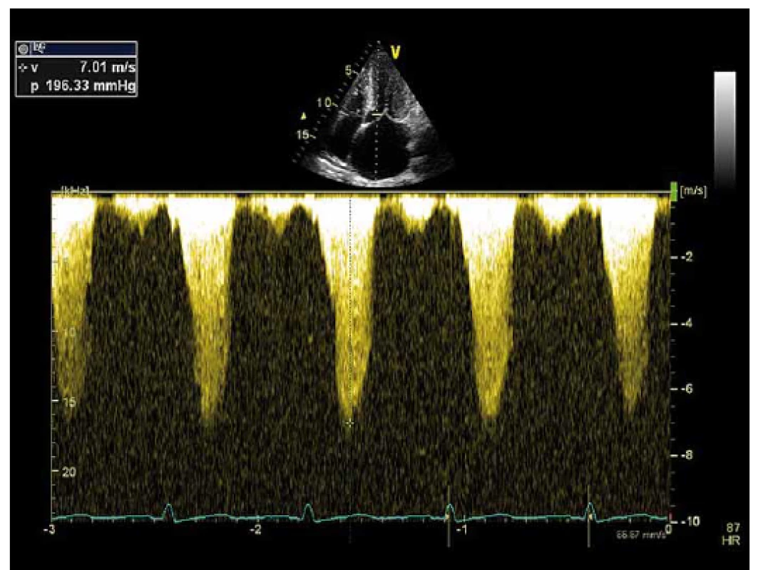 Maximální gradient ve výtokovém traktu levé komory měřený echokardiograficky pomocí kontinuální dopplerovské echokardiografie.