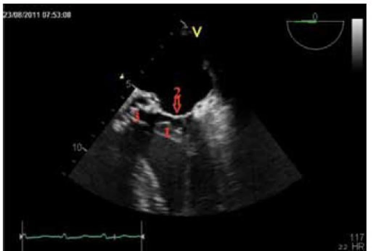 Transesophageální echokardiografie. Echogenní útvar vycházející z oblasti mitrální chlopně vlající do LVOT.
1 – akcesorní závěsný aparát mitrální chlopně, 2 – mitrální chlopeň, 3 – otevřená umělá aortální chlopeň