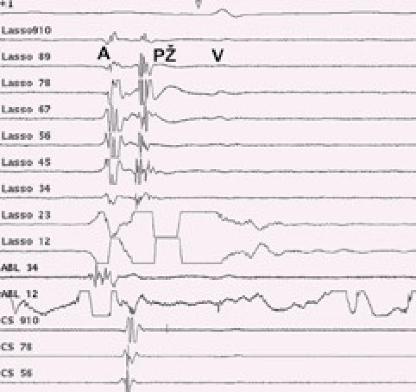 Elektrická izolace plicní žíly – intrakardiální EKG záznam.