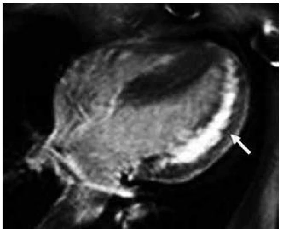Pozdní sycení kontrastní látkou postihující subendokardiální a midmyokardiální oblast celé volné stěny levé komory a hrotu u nemocného s Danonovou chorobou při vyšetření magnetickou rezonancí (čtyřdutinová projekce).