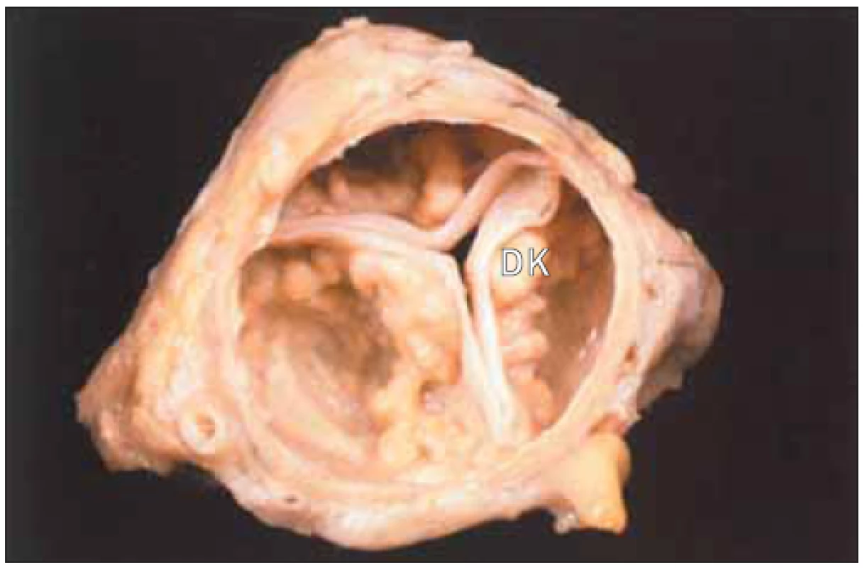 „Senilní“ aortální stenóza chlopně s 3 cípy a extrémními dystrofickými kalcifikacemi cípů ve vztahu k věku.