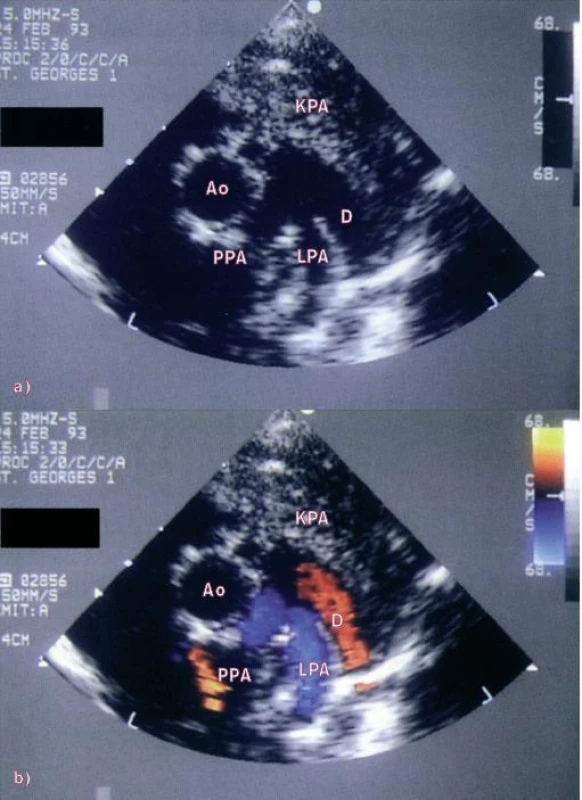a) Přetrvává-li fetální cirkulace, má ductus arteriosus stejnou velikost jako aorta a větvení plicnice, jak ukazuje charakteristický vzhled tří prstů na parasternálním pohledu v krátké ose. b) Barevné dopplerovské vyšetření ukazuje normální (modrou) plicní ejekci s nonrestriktivním levo-pravým (červeným) zkratem přes dučej