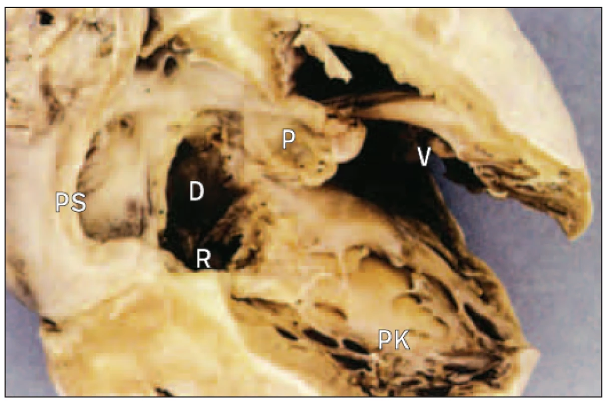 Pravá síň a komora v srdci s defektem septa síní typu ostium primum. Síňové septum je na bázi nedostatečné, ale prstence mitrální i trikuspidální chlopně jsou oddělené.