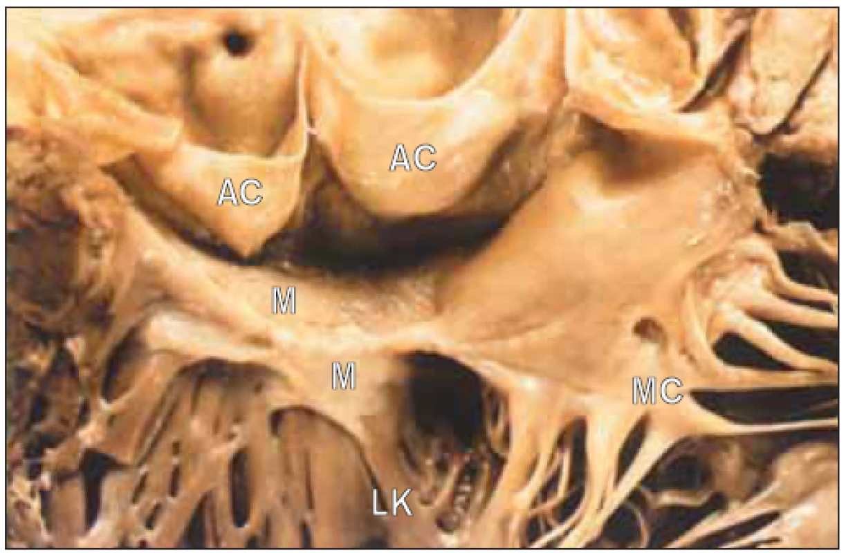 Aortální výtokový trakt v případě subvalvulární aortální stenózy. Membrána spojuje přední cíp mitrální chlopně s mezikomorovou přepážkou pod aortální chlopní.