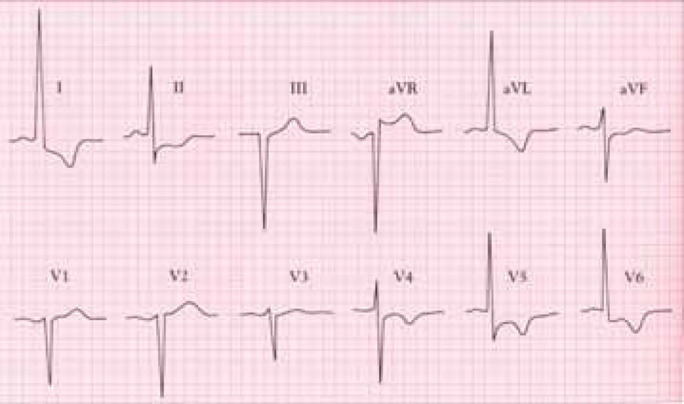 EKG u chronické aortální regurgitace ukazuje těžkou hypertrofii levé komory (tj. zvýšené voltáže a abnormality ST-T-typu strainu v laterálních svodech. Osa QRS ve frontální rovině směřuje doleva.