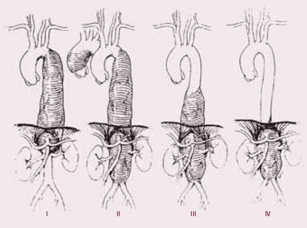Crawfordova klasifikace aneuryzmat torakoabdominální aorty.