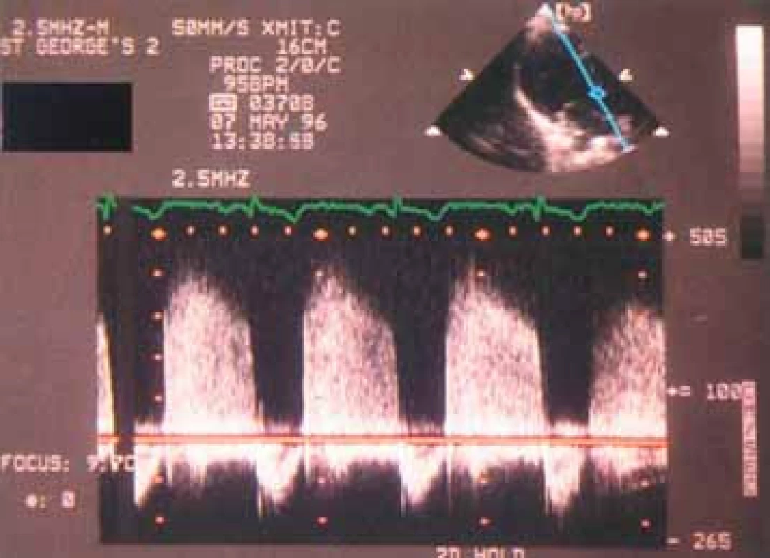 Kontinuální spektrální dopplerovská echokardiografie nabízí pohled do hemodynamiky aortální regurgitace. Rychlost regurgitačního jetu ukazuje rozdíl mezi aortálním a levokomorovým tlakem. Sklon na vrcholu spektrálního obrazu je měřítkem rychlosti, s jakou se tlakový rozdíl snižuje při poklesu aortálního a zvyšování komorového tlaku. (a) Lehká aortální regurgitace. Aortální diastolický tlak se snižuje normálně a levokomorový tlak se zvyšuje jen málo, takže během diastoly je udržována relativně velká tlaková diference.
(b) Středně těžká aortální regurgitace. Sklon je prudší a poukazuje na rychlý pokles aortálního tlaku a zvyšování komorového tlaku.