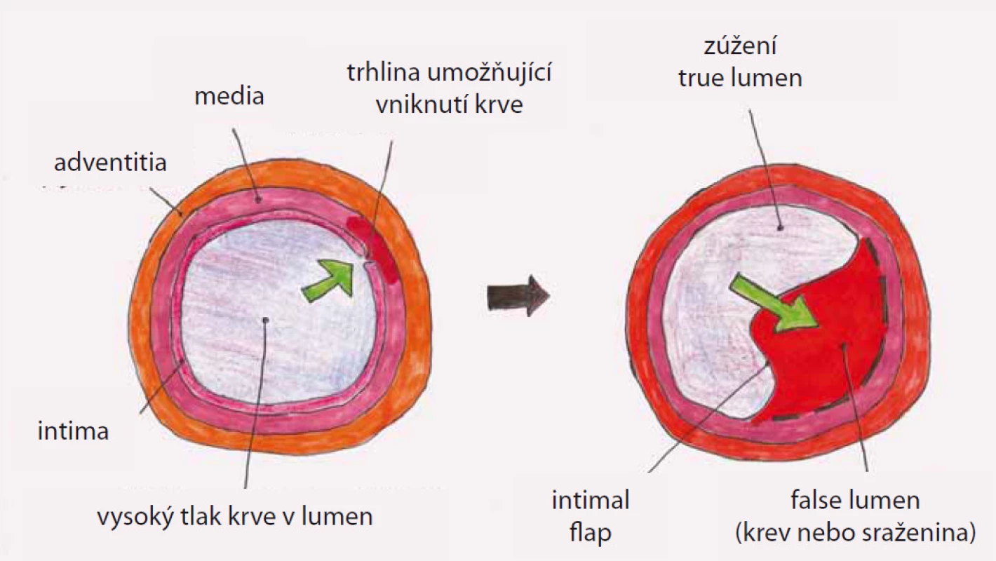 Princip vzniku disekce aorty. Disekce se začíná ve stěně cévy šířit z oblasti primární trhliny „intimal tear“ se vznikem pravého „true“ a falešného „false“ lumen. Pravý a falešný kanál je od sebe oddělen membránou „intimal flap“.