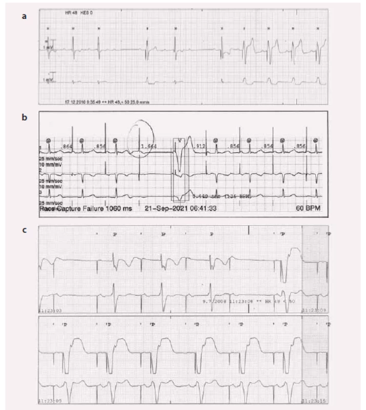 EKG u algoritmu na snížení komorové stimulace.