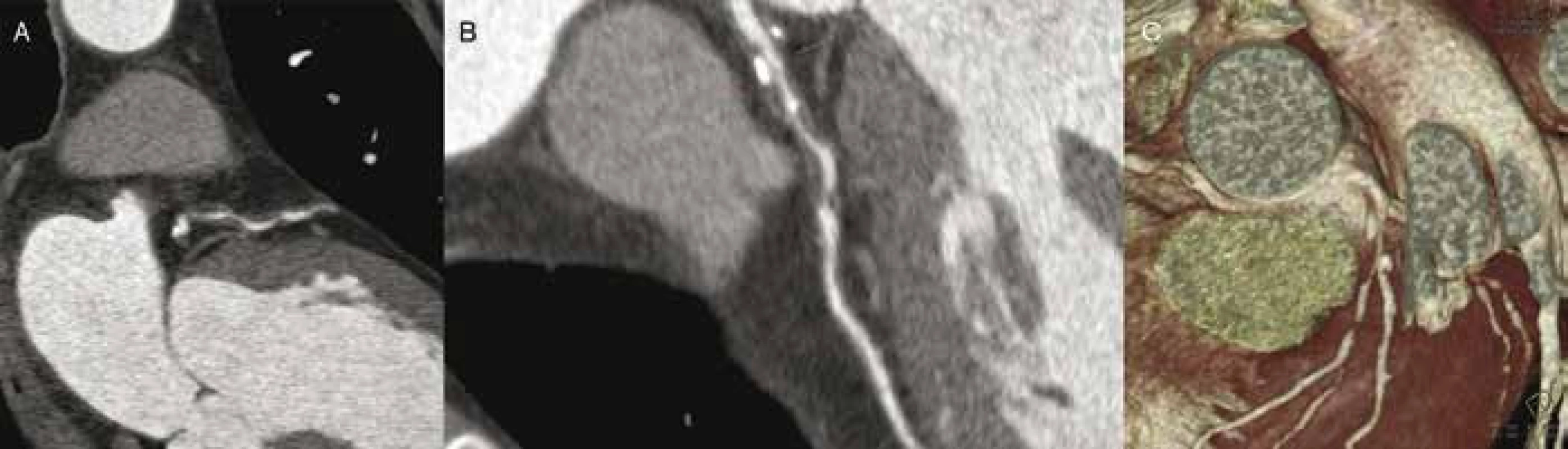 CT angiografie: rozsáhlé postižení proximální a střední třetiny RIA fibrózními pláty (A–B) s několika kalcifikacemi, které způsobují až hemodynamicky významnou stenózu (C) u osoby s vysokým kardiovaskulárním rizikem bez anamnézy klinických potíží.