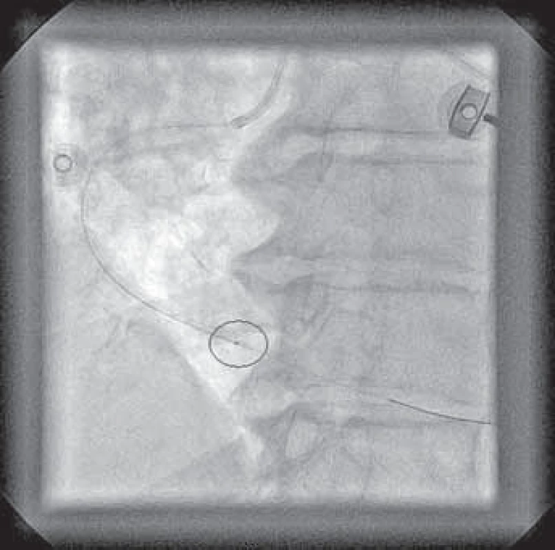 Pacient č. 1 – zavedený tromboaspirační katétr s RTG-kontrastní značkou na jeho konci.