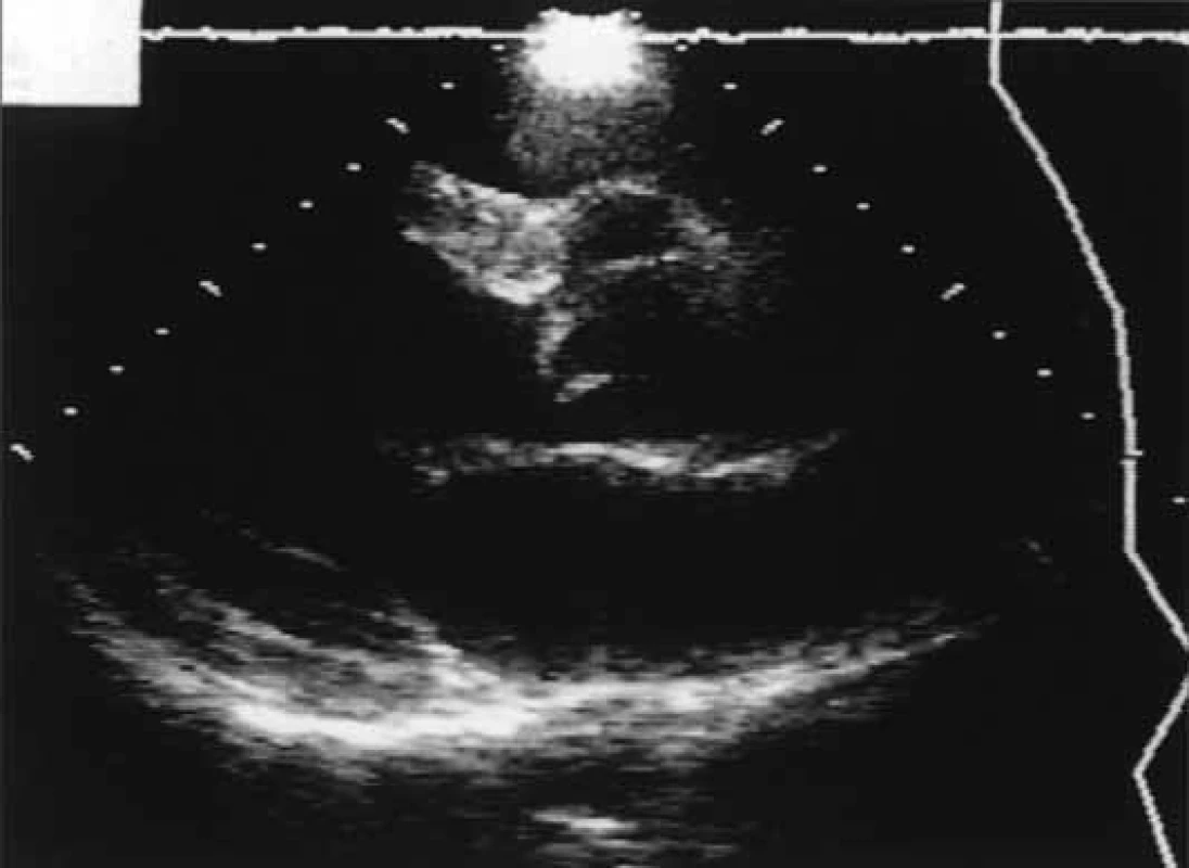 Parasternální pohled v dlouhé ose ukazuje velké mykotické aneuryzma aortálního kořene. Perforace cípu a komunikace mezi aortou a aneuryzmatem při bázi cípu (potvrzeno chirurgicky).
