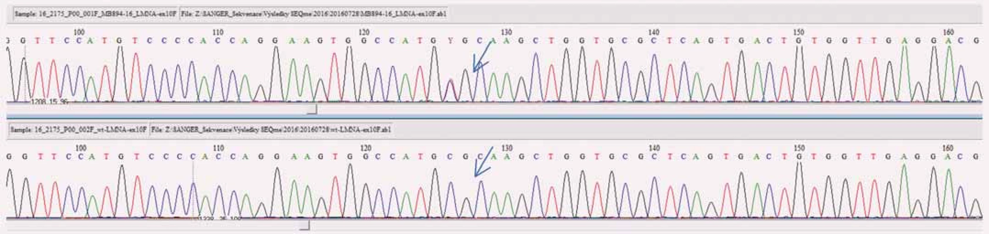 Výstup z analýzy varianty c.1621 &gt; T v genu &lt;i&gt;LMNA&lt;/i&gt; Sangerovým sekvenováním (šipkou je vyznačena daná varianta u pacienta – horní obrázek, na spodním obrázku je sekvence bez této varianty (wild type).