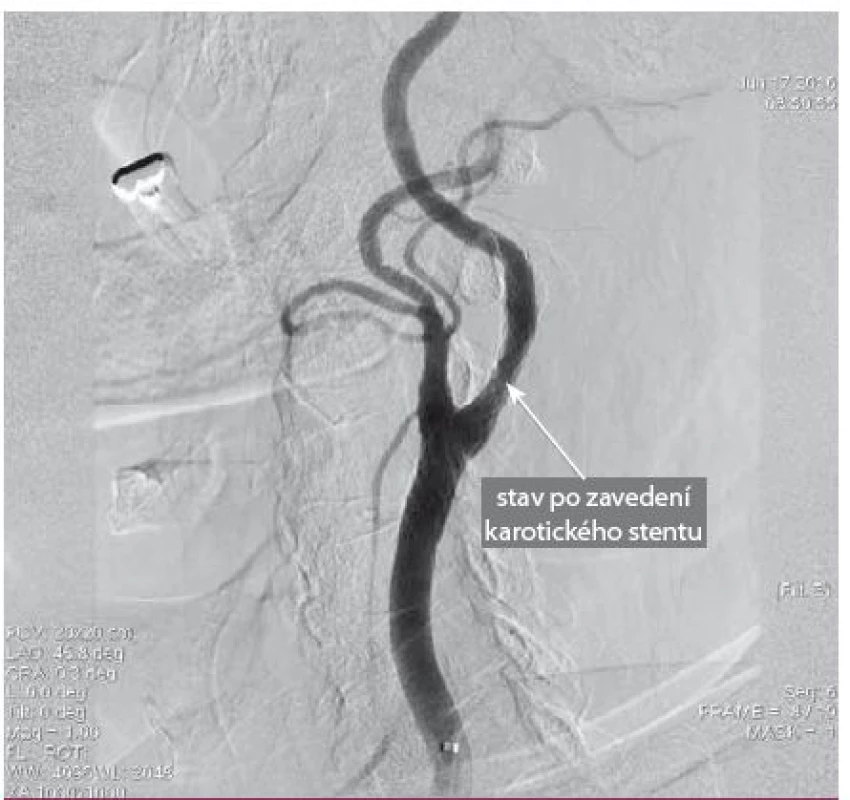 Kontrolní DSA angiografie po implantaci stentu. Implantovaný stent je systém „Double Layer Mesh Stent Technology“.