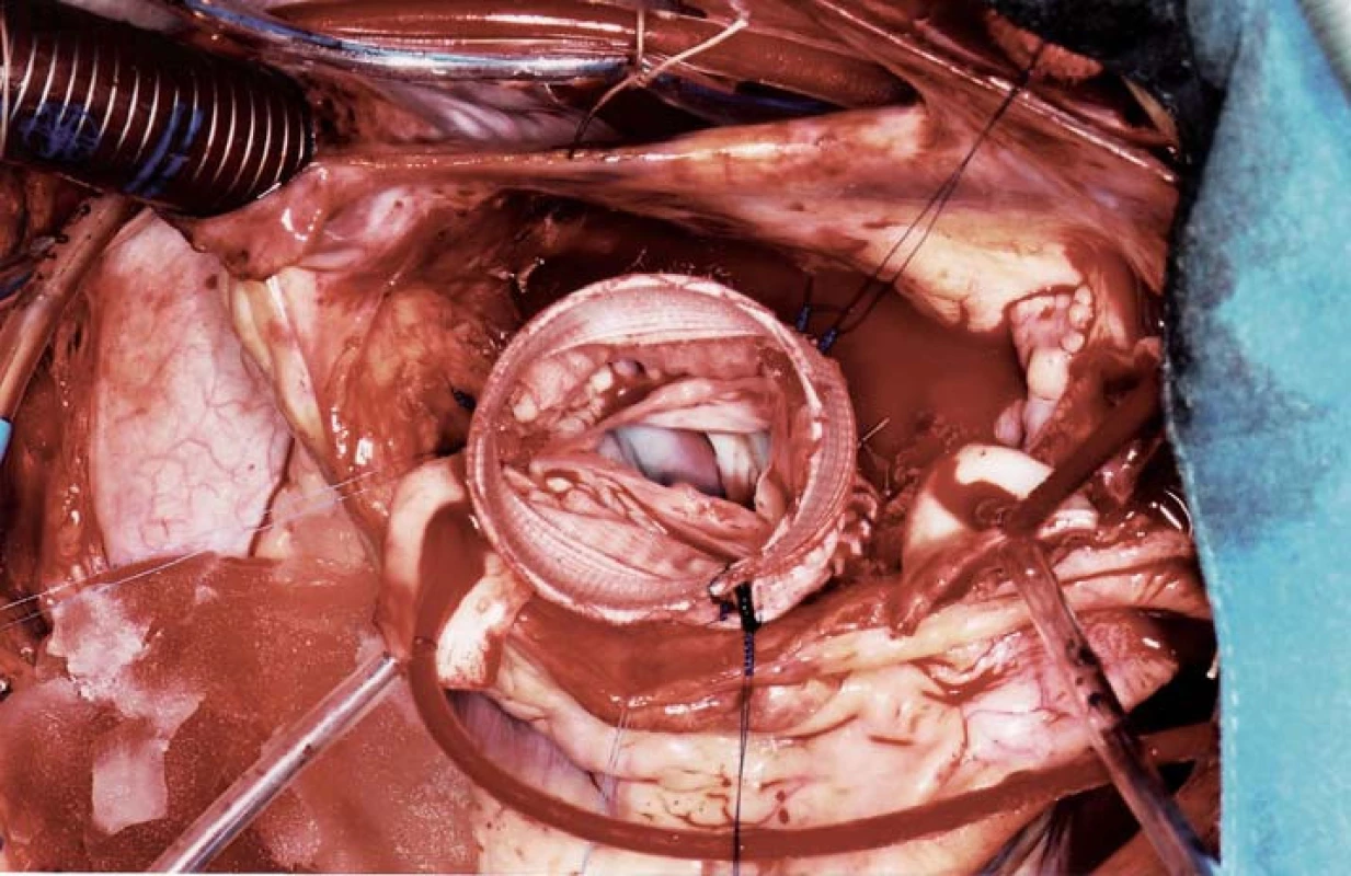 Chirurgické řešení Marfanova syndromu se zachováním vlastní aortální chlopně, která je implantována do cévní protézy 