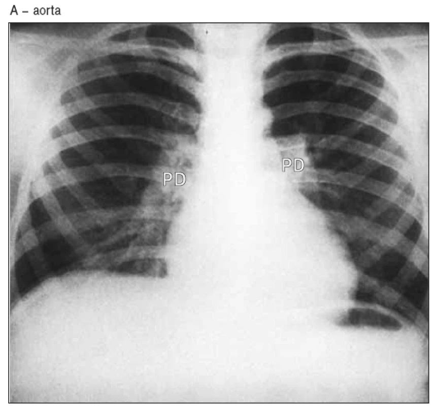 RTG hrudníku u supravalvulární stenózy aorty sdružené s centrální stenózou plícnice. Aortální oblouk je nerozeznatelný, je poststenotická dilatace plícnice.