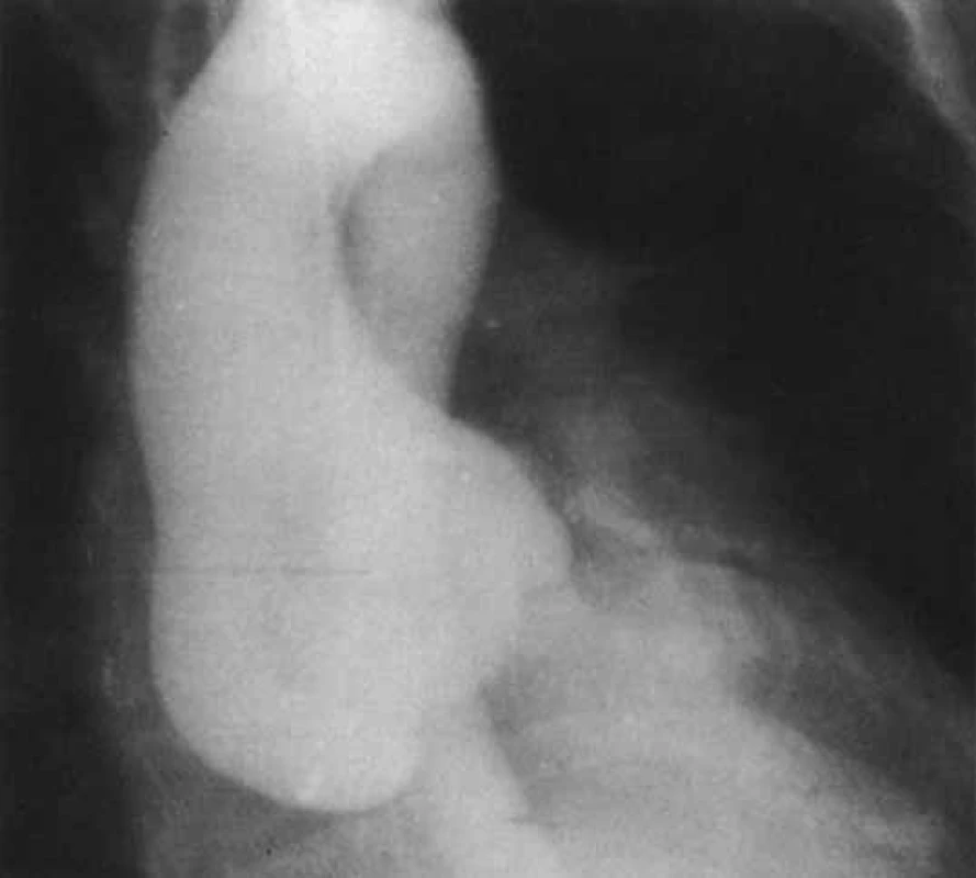 Aortogram v antero-posteriorní projekci ukazuje dilataci aortálního kořene u Marfanova syndromu.