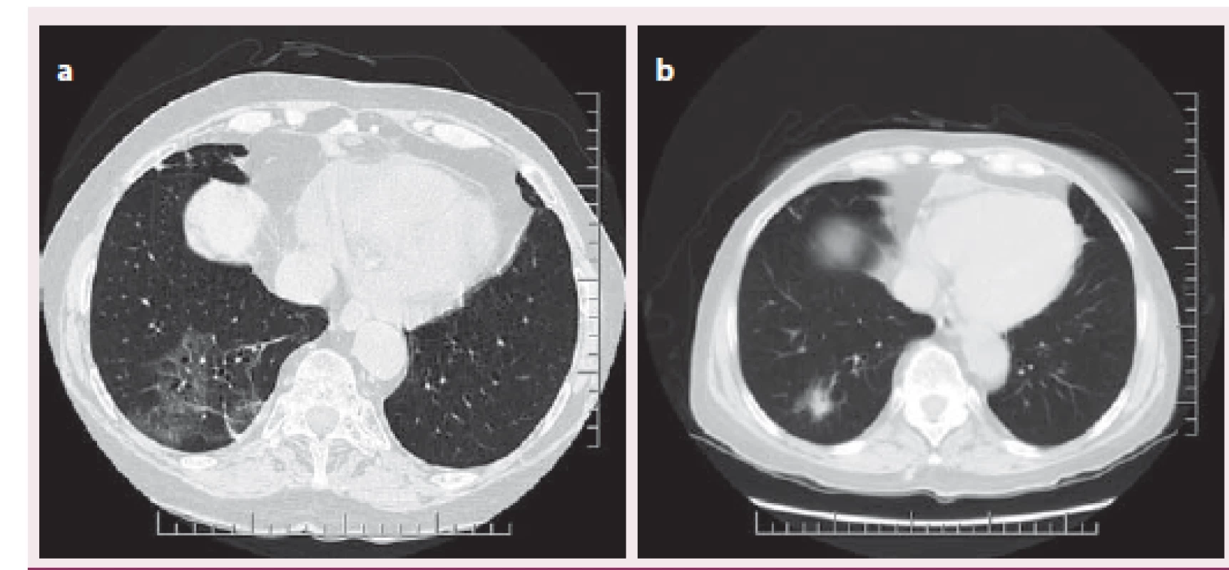 CT/HRCT plic (plicní okno) ukazující zánětlivé změny charakteru mléčného skla v dolním laloku pravé plíce.