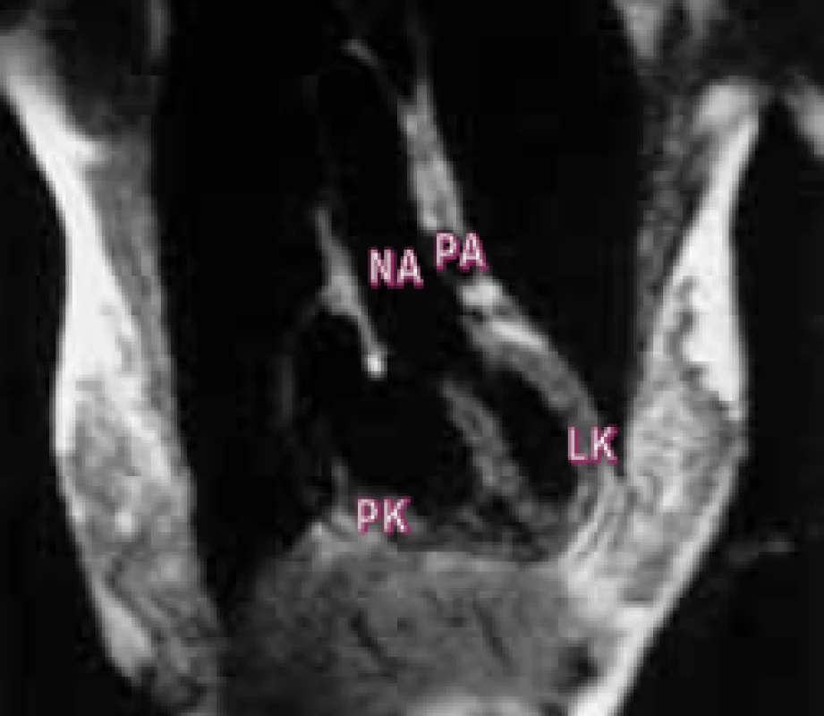 MR spin echo v koronální rovině znázorňuje Fallotovou tetralogii – zřetelný defekt a nasedající aortu.
