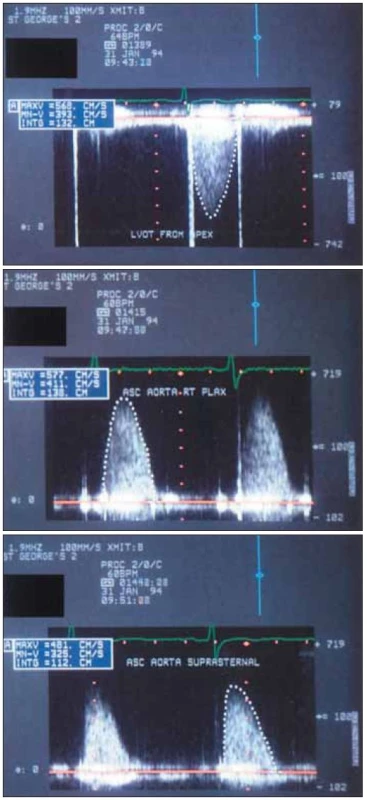 Záznam kontinuálním spektrálním dopplerovským vyšetřením z hrotu (nahoře), pravého horního parasternálního okraje (uprostřed) a suprasternálně (dole) u mladého muže s hlasitým systolickým šelestem. Vrcholový gradient je vyšší než 130 mmHg, se stejnými hodnotami z hrotu a pravé parasternální hrany. To dokládá, že oba směry paprsku jsou v podstatě sdružené, a potvrzuje technickou správnost záznamu.