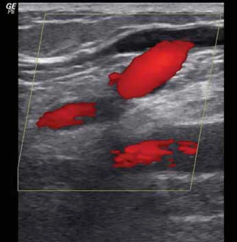 Ultrazvukový průkaz patofyziologie – refl ux v safénopopliteální junkci, vlevo fyziologický dopředný tok, vpravo refl ux při kompresi stehna nad sondou (barevné mapování krevního toku).