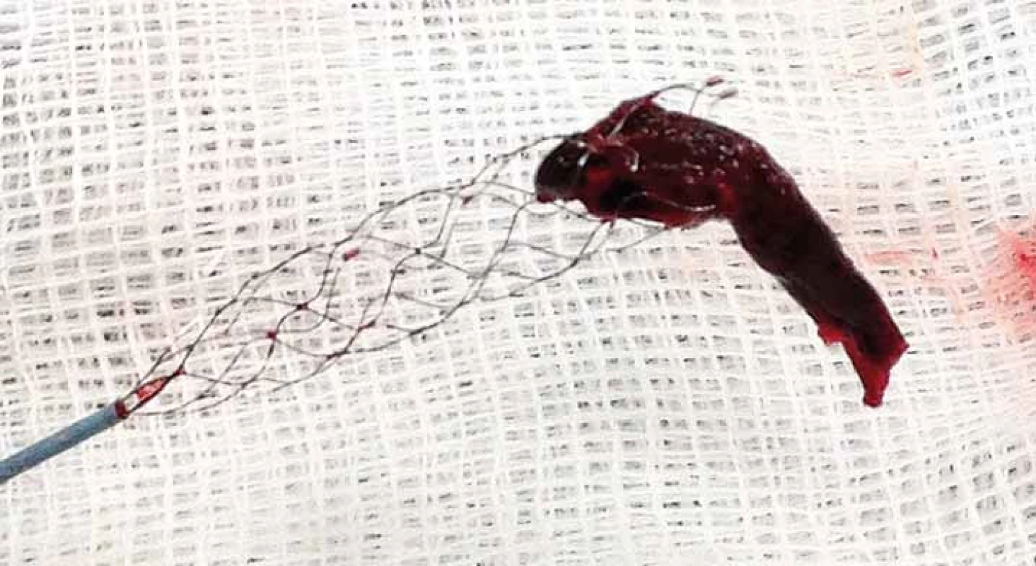 Fotografie stent-retrieveru s embolem po vytažení z M1 úseku ACM l.dx.
