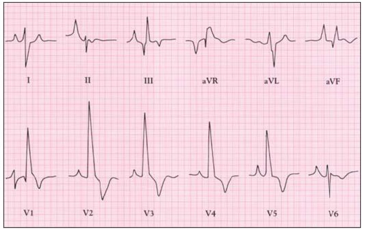 EKG u Ebsteinovy anomálie s vysokými vlnami P a BPR.
