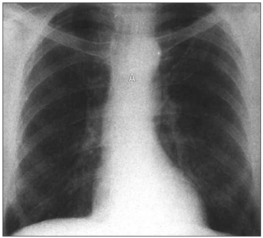 RTG hrudníku u supravalvulární stenózy. Srdce je tvarem normální a vzestupná aorta nerozeznatelná.
