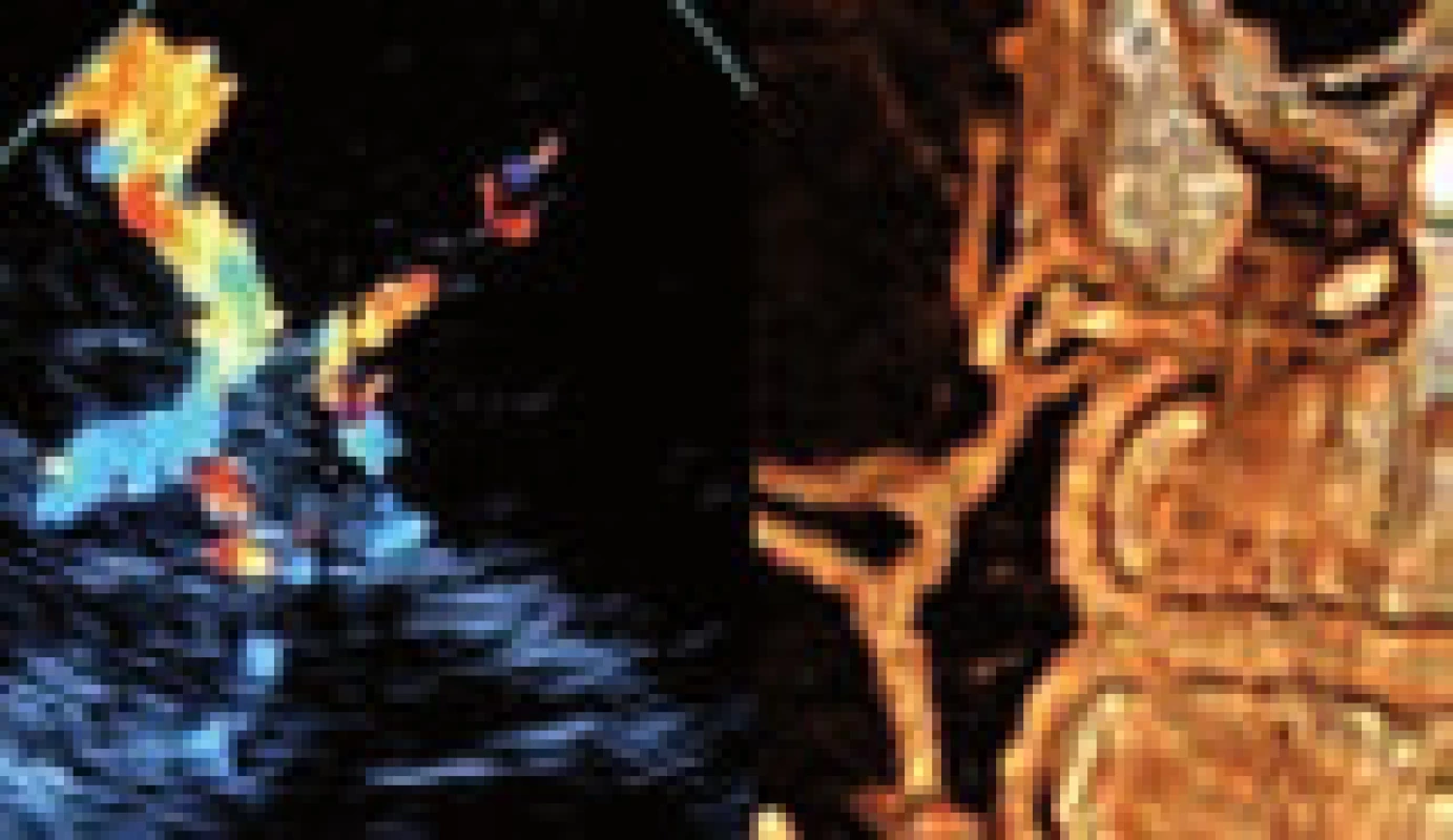 Tepny mozkové cirkulace (Willisova okruhu) při TCCS vyšetření ve srovnání s CT angiografickou rekonstrukcí.
