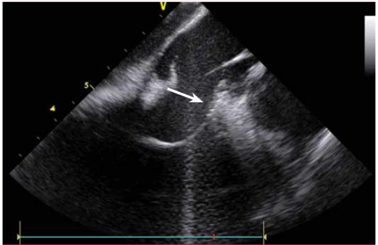 Ablace komorové extrasystolie z oblasti komisury levé a pravé koronární kapsičky aorty, hrot katetru zavedený retrográdně přes aortální chlopeň do levé komory a následně back-loopem do oblasti komisury ze strany levé komory.