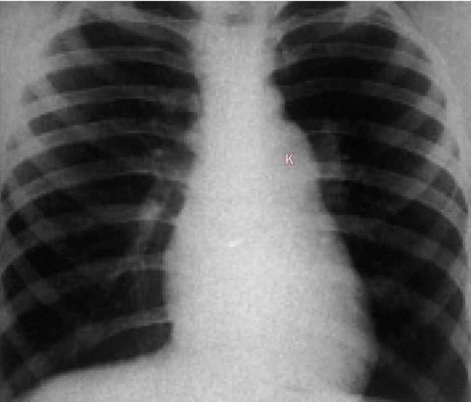 Skiagram ukazuje zřetelnou poststenotickou dilataci levé plicní arterie.