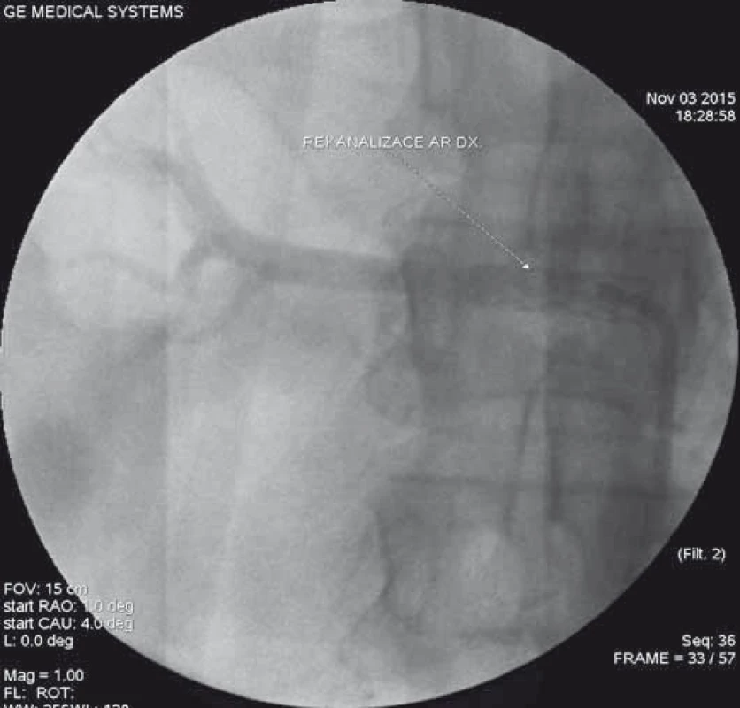 Kontrolní angiografie po zavedení stentu do pravé renální tepny s obnovením plnění parenchymu ledviny.