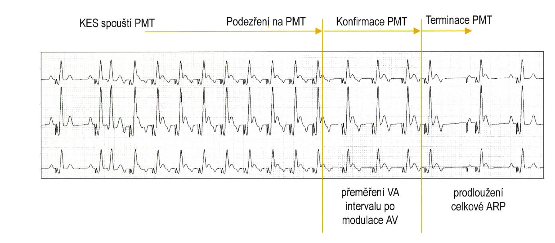 Pacemakerová tachykardie spuštěná komorovou extrasystolou je detekována po 8 konsekutivních stazích se stabilním VA-intervalem stimulace komor spouštěné síněmi (podezření na PMT). Potvrzení (konfirmace) je provedeno přeměřením VA-intervalu po modulaci (zkrácení či prodloužení) AV delay. Pokud je PMT potvrzena, je jednorázovým prodloužením atriální refrakterní periody (ARP) docíleno časování retrográdního P do refrakterity, a tím terminace PMT. (zdroj: Biotronik Philos II. Výukový materiál)