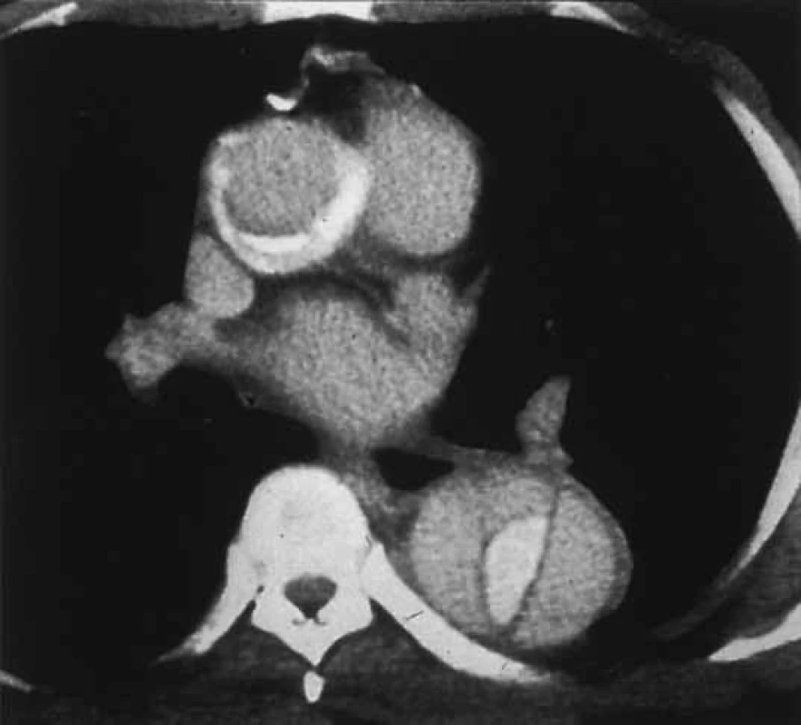CT u aortální disekce v transaxiální rovině. Jde o komplikovanou disekci postihující jak sestupnou, tak vzestupnou aortu. Intravenózní kontrast se objevil v pravém lumen a ve vzestupné aortě vytvořil lem, v sestupné aortě se centralizoval.

