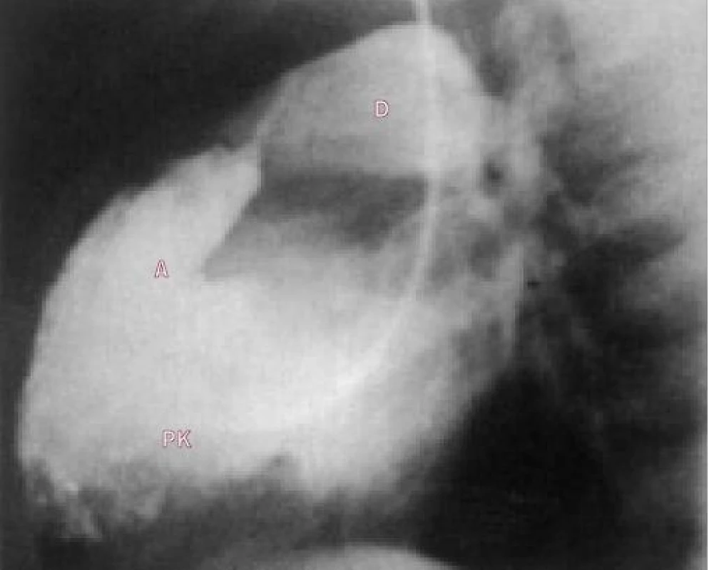 Jiný rámeček od téhož pacienta ukazuje poststenotickou dilataci plicní arterie.