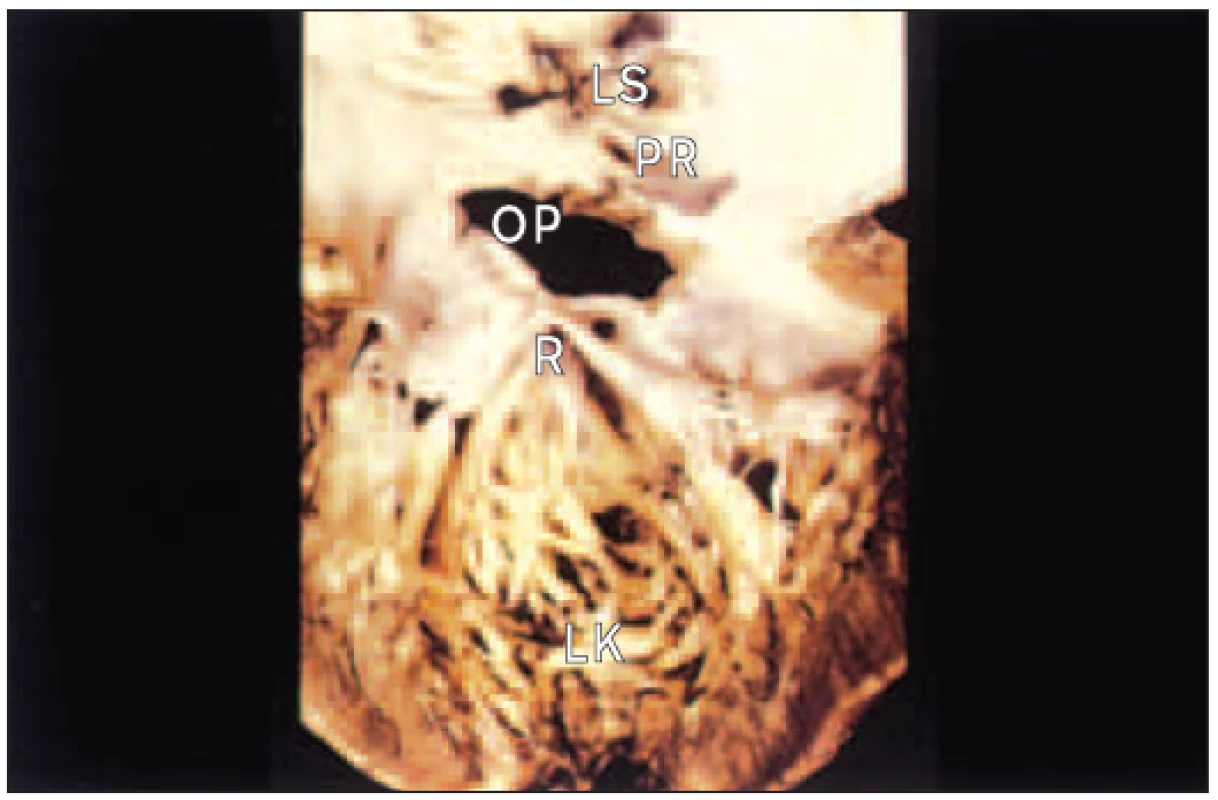 Levá síň a komora po operaci defektu septa síní typu ostium primum. Rozštěp cípu mitrální chlopně.